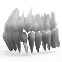 des restaurations sur implants pour garder sa force à votre bouche et votre sourire