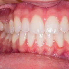 gum treatment: reduce the impact of the periodontal disease